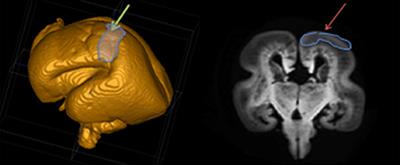 Growth of Thalamocortical Fibers to the Somatosensory Cortex in the Human Fetal Brain